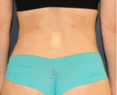 Feel Beautiful - Liposuction Back-Flanks 211 - After Photo